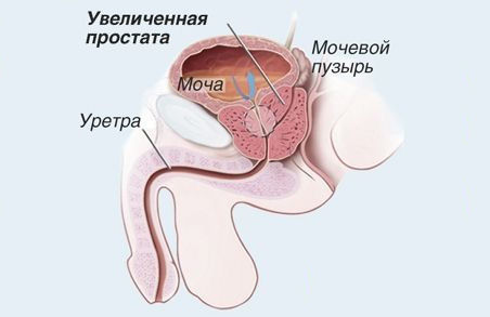 Простатит