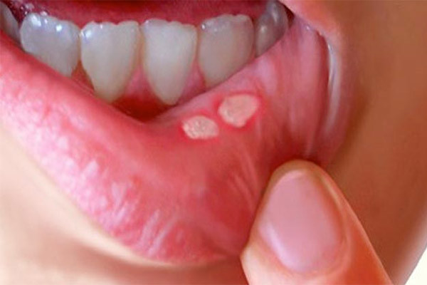 Аллергические заболевания полости рта