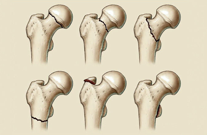 Современное состояние проблемы хирургического лечения пострадавших с переломами шейки бедренной кости