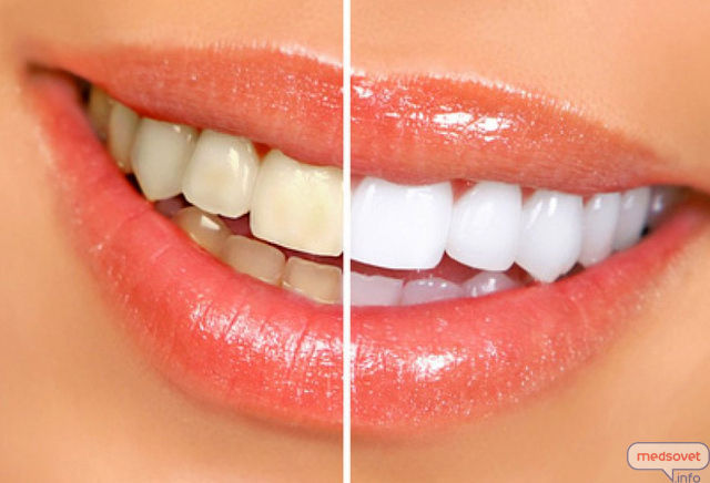 Отбеливание зубов – основные аспекты