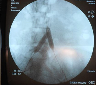 Рис. 2. Баллонная окклюзия общих подвздошных артерий под рентгенологическим контролем