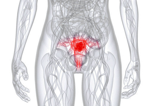 Рак шейки матки – как предупредить болезнь?