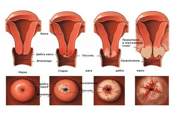 Рак шейки матки – стадии болезни