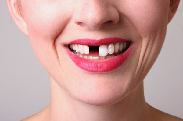 Протезирование жевательных зубов: сделать сейчас или когда-нибудь потом?