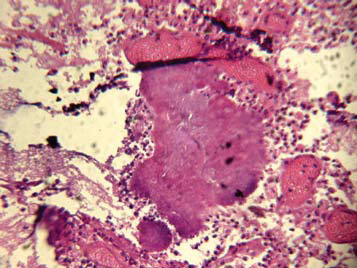 Рис. 6. Базофильные микробные колонии, напоминающие друзы лучистого гриба – актиномицеты.