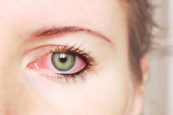 Симптомы сухого глаза