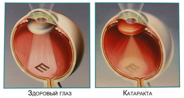 Катаракта