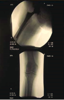 Рис. 1. Рентгенограмма тазобедренного сустава после операции тотального эндопротезирования правого тазобедренного сустава от 26.02.2006 г.