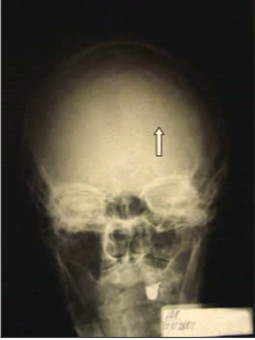 Рис. 2. Рентгенограмма черепа, солитарный миеломный очаг (указан стрелкой)