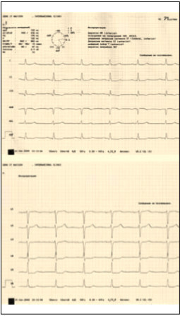 Фото 1, 2. ЭКГ пациентки демонстрирует нарушения реполяризации, характерные для вероятного ишемического повреждения миокарда ЛЖ.