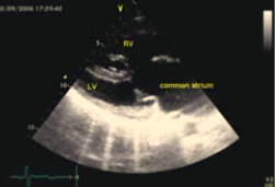 Фото 4.  Длинная парастернальная ось, видны: единое предсердие (common atrium) и сообщающиеся левый и правый желудочки (LV, RV); гребень-зачаток межжелудочковой перегородки в верхушке сердца, единый атриовентрикулярный клапан; крепление задней створки клапана — к гребню МЖ