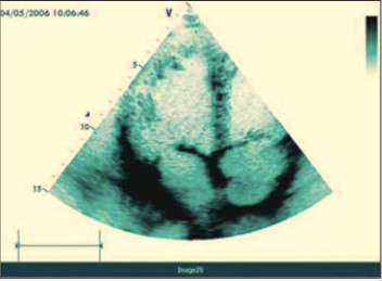 Фото 2. Эхокардиограмма пациента с незначительной сердечной недостаточностью: левый атриовентрикулярный (митральный) клапан открыт, правый атриовентрикулярный (трехстворчатый) клапан закрыт
