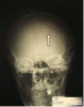 Рис. 6. Рентгенограмма черепа, солитарный миеломный очаг (указан стрелкой)
