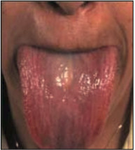 Рис. 3. Увеличенный язык при амилоидозе