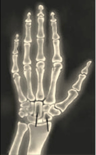 Рис. 4. Рентгенограмма костных кист или карпорадиальный синдром