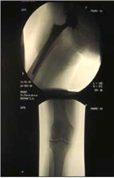 Рис. 5. Рентгенограмма тазобедренного сустава после операции тотального эндопротезирования правого тазобедренного сустава от 26.02.2006г.