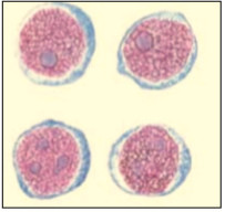  Рис 1. Микроскопический вид лимфобластов