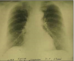 Рис. 3. Изменения в лёгких в пределах возрастной нормы (апрель 2007 г.)