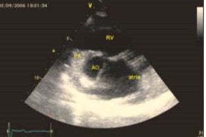 Рис. 5. Короткая парастернальная ось: единое предсердие (atria) и доминирующий правый  желудочек (RV)