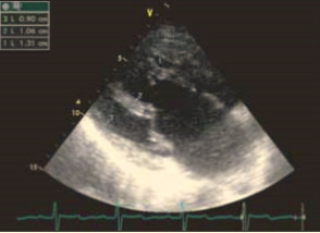 Рис. 12. Морфометрия сердца в В-режиме; визуализация прикрепления передней створки митрального клапана к передней стенке общего желудочка