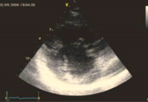 Рис. 6. Верхушечная позиция: единый желудочек, единый атрио-вентрикулярный клапан и единое предсердие