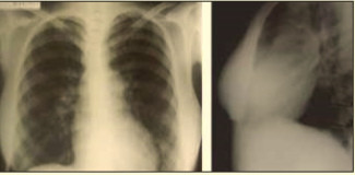 Рис. 3. Рентгенограммы органов грудной полости пациентки. Умеренное увеличение желудочков сердца. Корни легких расширены