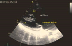 Рис. 7. Длинная парастернальная ось, видны: единое предсердие (common atrium) и сообщающиеся левый и правый желудочки (LV, RV); гребень-зачаток межжелудочковой перегородки в верхушке сердца, единый атрио-вентрикулярный клапан; крепление задней створки клапана — к гребню МЖП