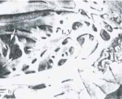 Рис. 3. Тромбы в межтрабекулярных простран- ствах некомпактного миокарда левого желудочка