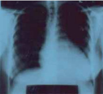 Рис. 14. Рентгенограмма органов грудной полости пациентки А. Выраженное расширение ЛЖ. Корни легких расширены, левое легкое поджато за счет увеличенного сердца — влево и вверх