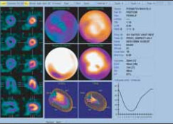 Рис. 11. Сцинтиграфия миокарда с процессинговым компьютерным моделированием сердца