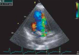 Рис. 9. Выраженная аортальная регургитация вследствие отрыва некоронарной створки аортального клапана при цветном допплеровском картировании в рамках ЭХО-кардиографического исследования. 