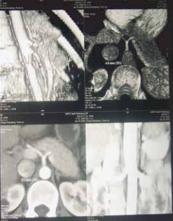 Рис. 3. Диагностика стеноза чревного ствола при магнито-резонансной томографии сосудов брюшной полости
