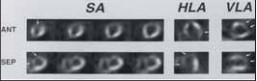 Рис. 12. Сцинтиграфия миокарда с технецием: стрелками показаны дефекты накопления радио-фармпрепарата при остром инфаркте миокарда. SA — короткая ось; HLA — горизонтальный срез по длинной оси; VLA — вертикальный срез по длинной оси; ANT — передняя стенка; SEP — перегородка; LAT — боковая стенка; INF — нижняя стенка ЛЖ