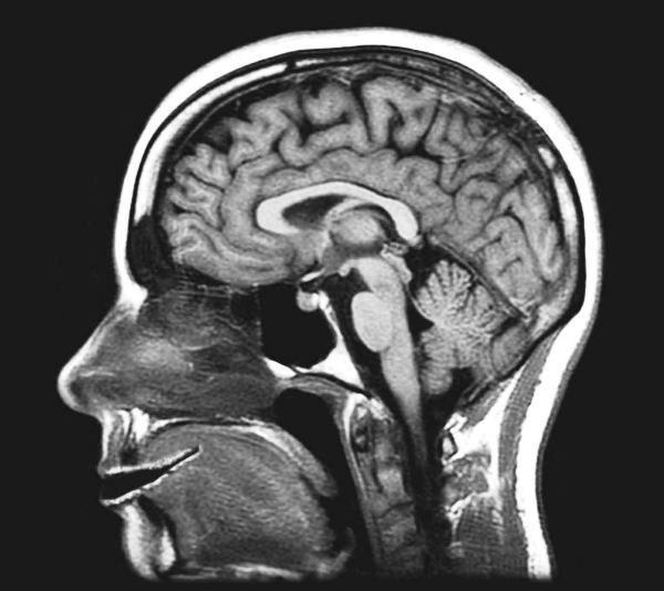 МРТ головного мозга: есть ли вред?