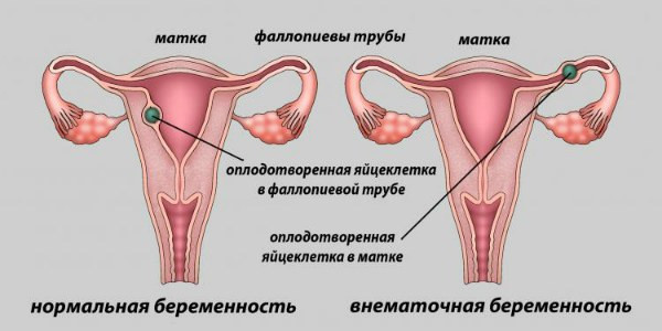 Тест При Внематочной Беременности Фото