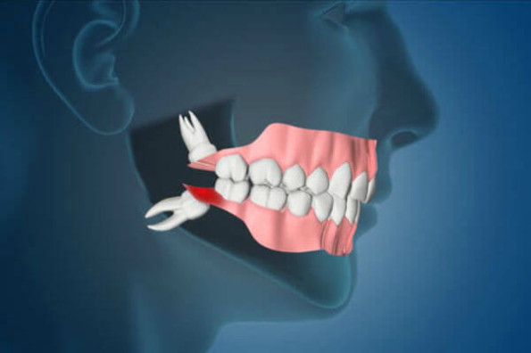 Зубы мудрости — 8-й зуб в ряду