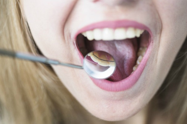 Опечатки зубов по краям языка говорят о дисбактериозе 