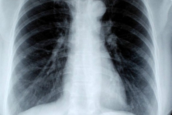 Из-за патологий лёгких может возникать одышка 