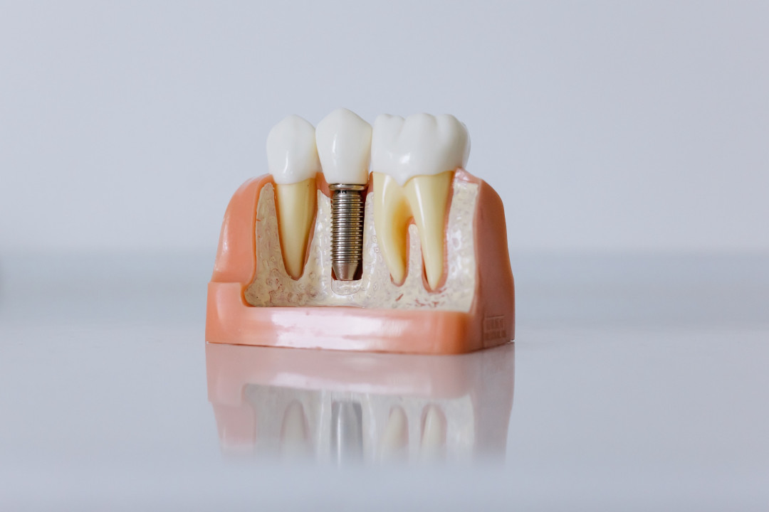 Имплантация зубов: правила успеха