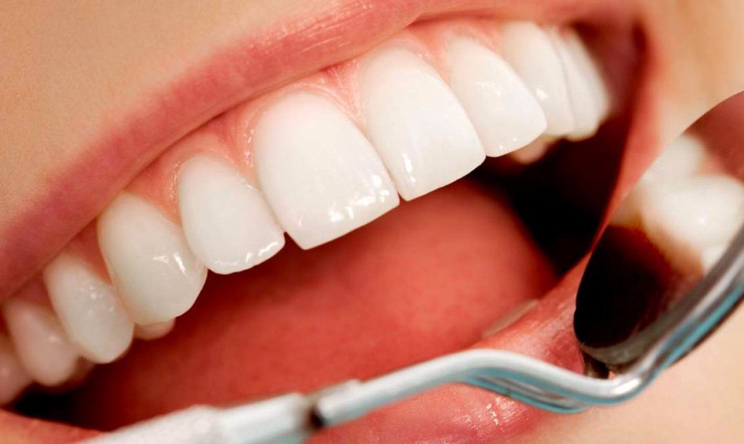 Идеальный внешний вид зубов – это установка виниров 